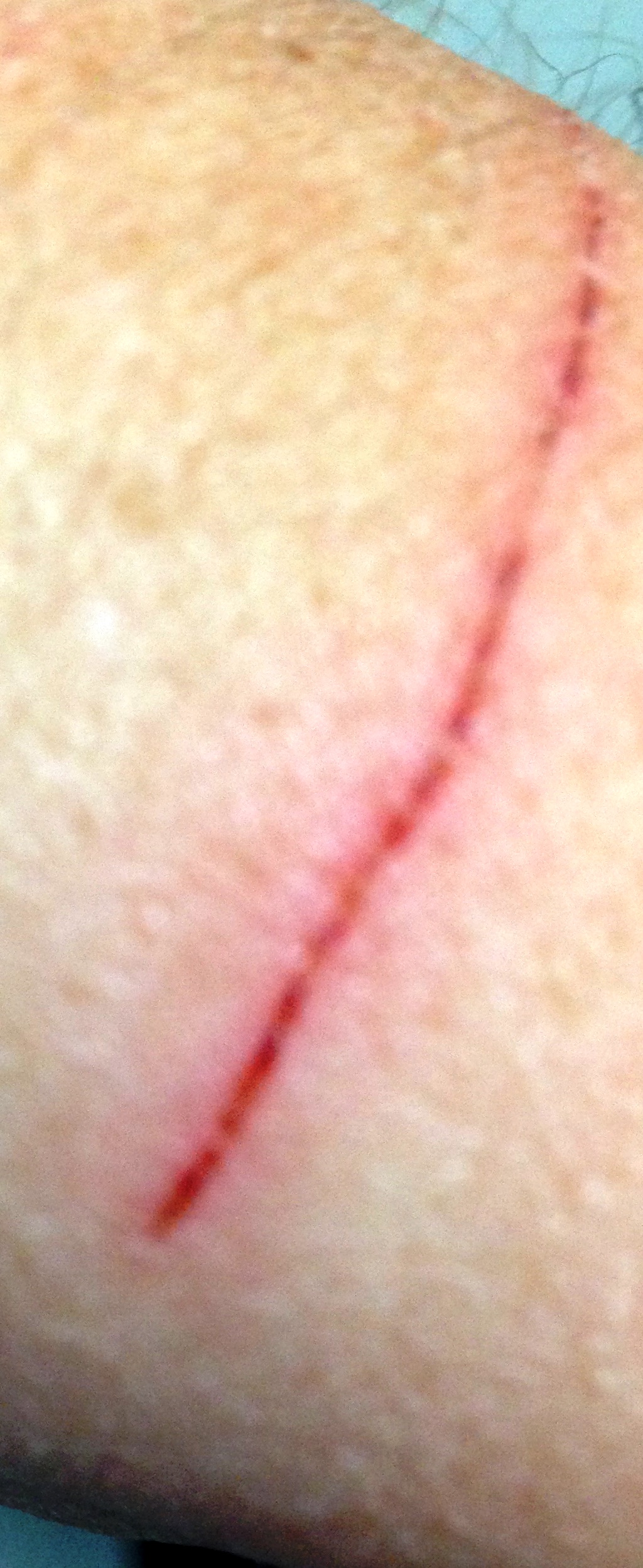 warriorwound